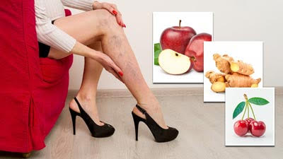 वेरीकाज वेन की समस्या में कौन कौन सी चीजों का सेवन करना चाहिए?