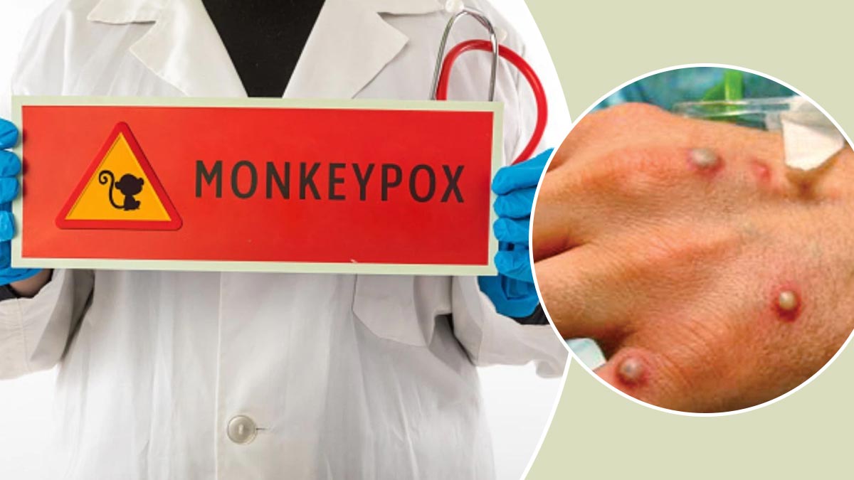 Monkeypox: मंकीपॉक्स के चलते देश के इन राज्यों में अलर्ट, WHO ने बताए 6 गंभीर लक्षण, जानें जरूरी बातें