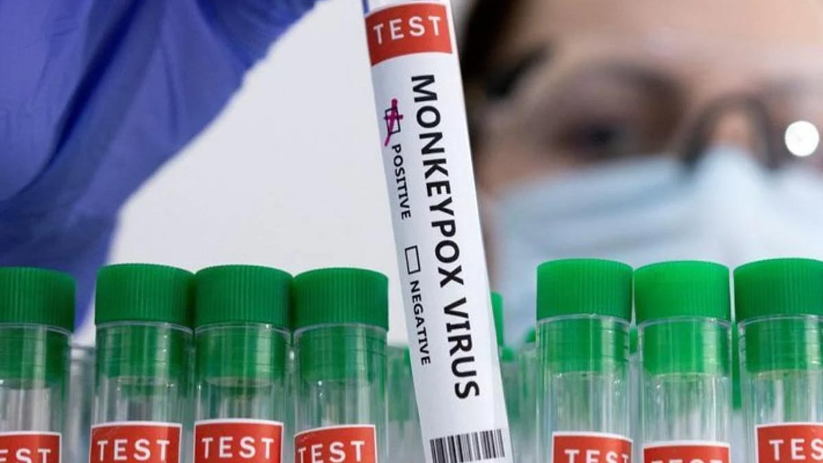 monkeypox virus infection symptoms