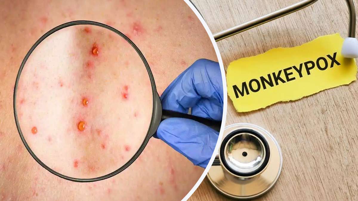 Monkeypox: तेजी से फैल रहा मंकीपॉक्स वायरस, कैसे पहचानें मंकीपॉक्स से संक्रमित हैं या नहीं?