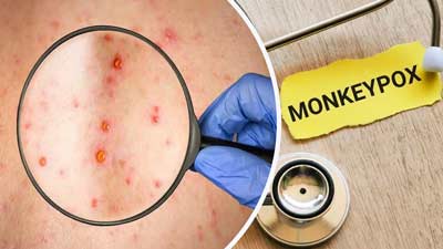 Monkeypox: तेजी से फैल रहा मंकीपॉक्स वायरस, कैसे पहचानें मंकीपॉक्स से संक्रमित हैं या नहीं?