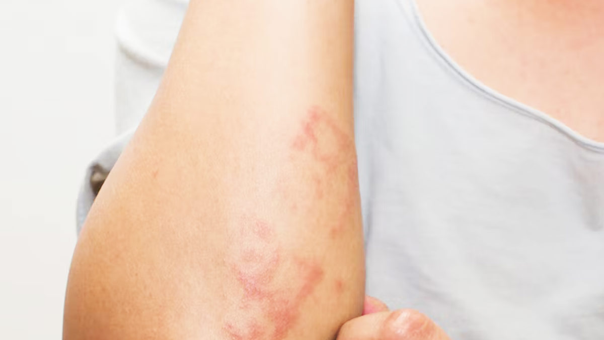 jojoba oil for skin disorder