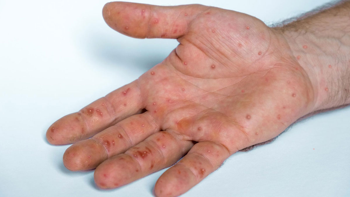 WHO on Monkeypox Pandemic