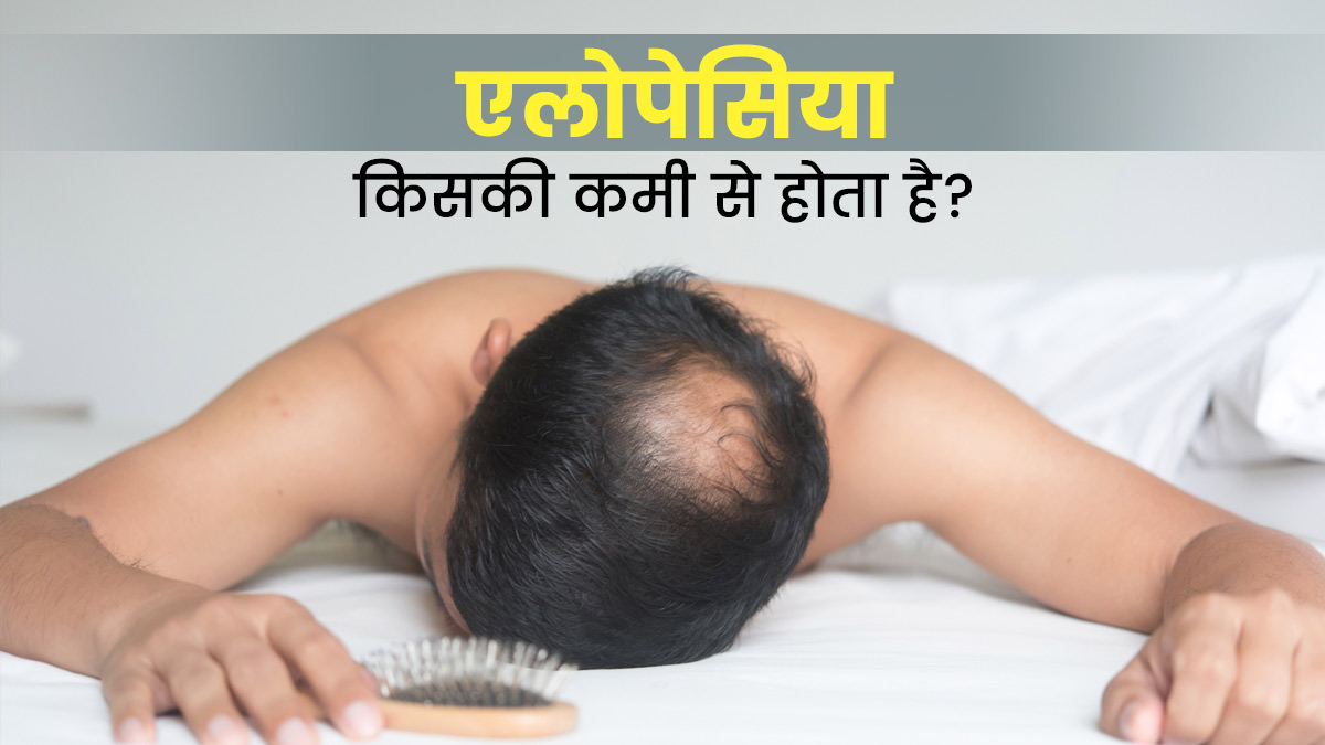 बाल झड़ने की बीमारी एलोपेसिया किसकी कमी से होती है? जानें कारण और इलाज