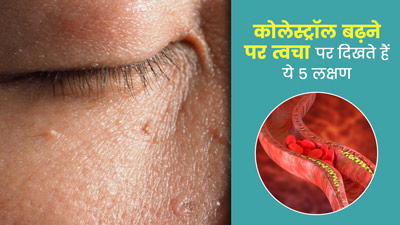 कोलेस्ट्रॉल बढ़ने पर त्वचा पर दिखते हैं ये 5 लक्षण, न करें नजरअंदाज