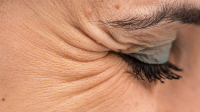 Crow's Feet: आंखों के किनारे फाइन लाइन्स (क्रो फीट) क्यों होते हैं? जानें इसे दूर करने के उपाय