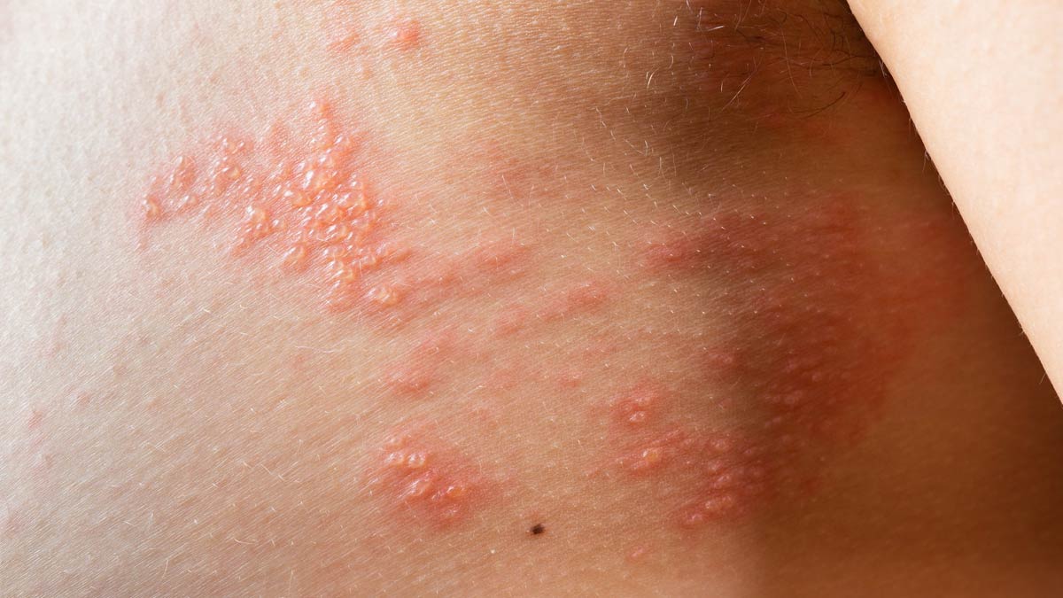 Shingles: Know Its Causes, Symptoms And Treatment