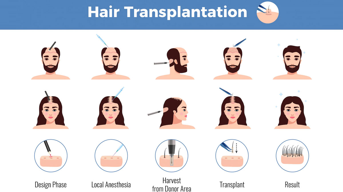 Pros and Cons of Hair Transplantation