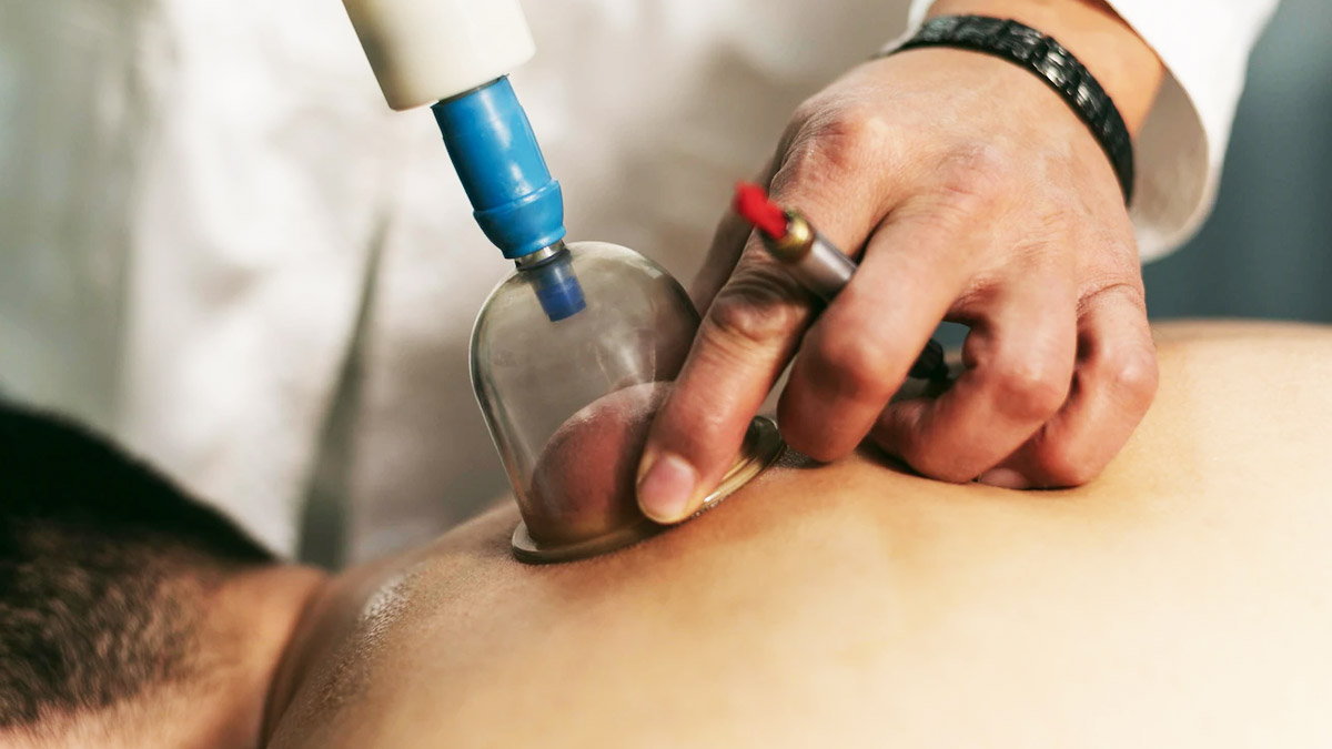 Cupping-Therapy
