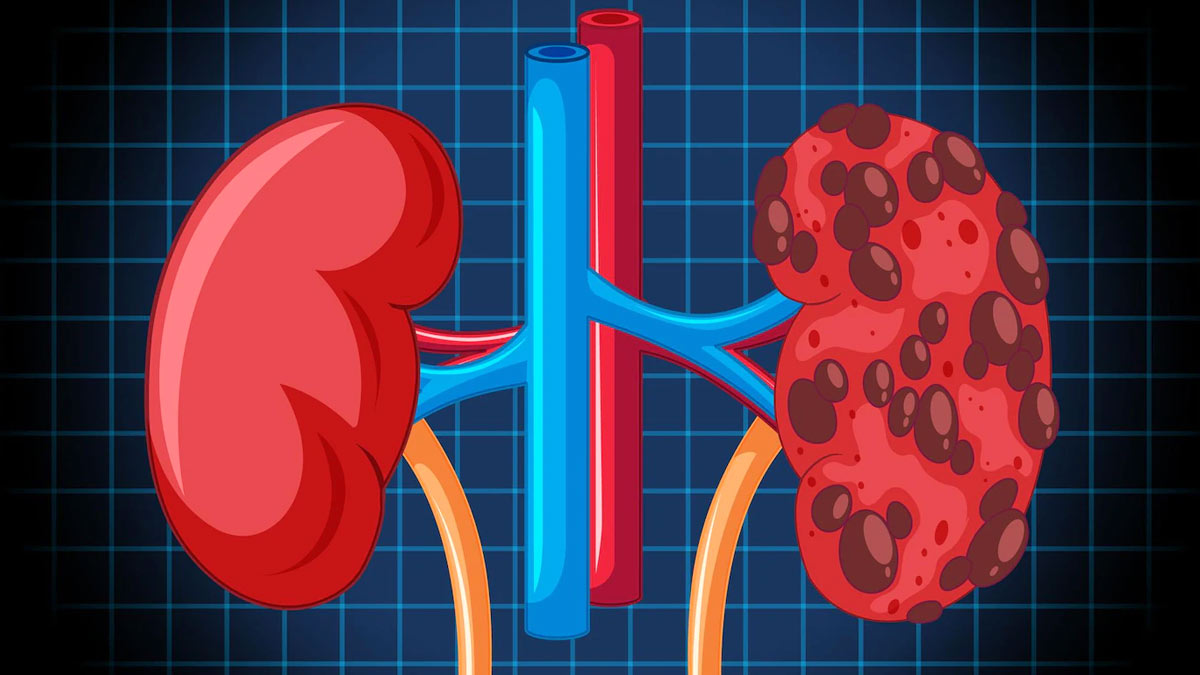 kidney disease diabetes