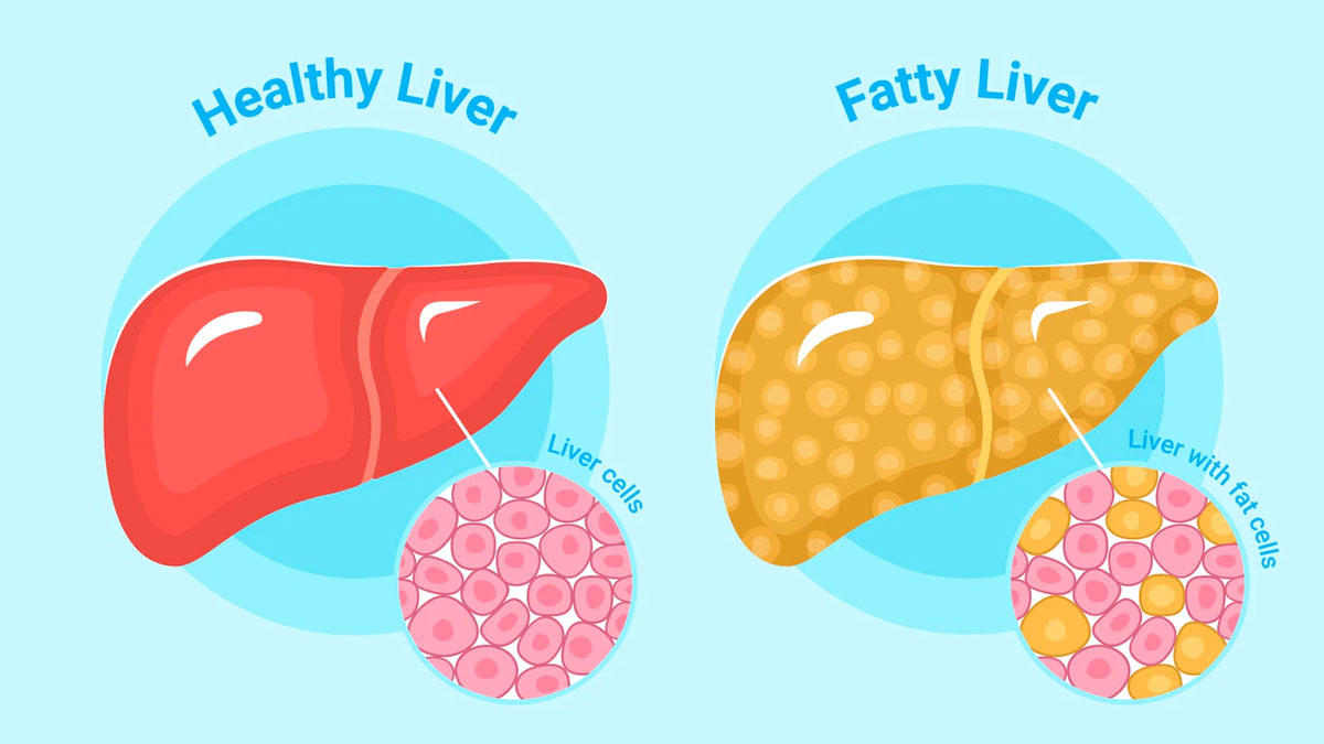 Fatty Liver Dietary Modifications
