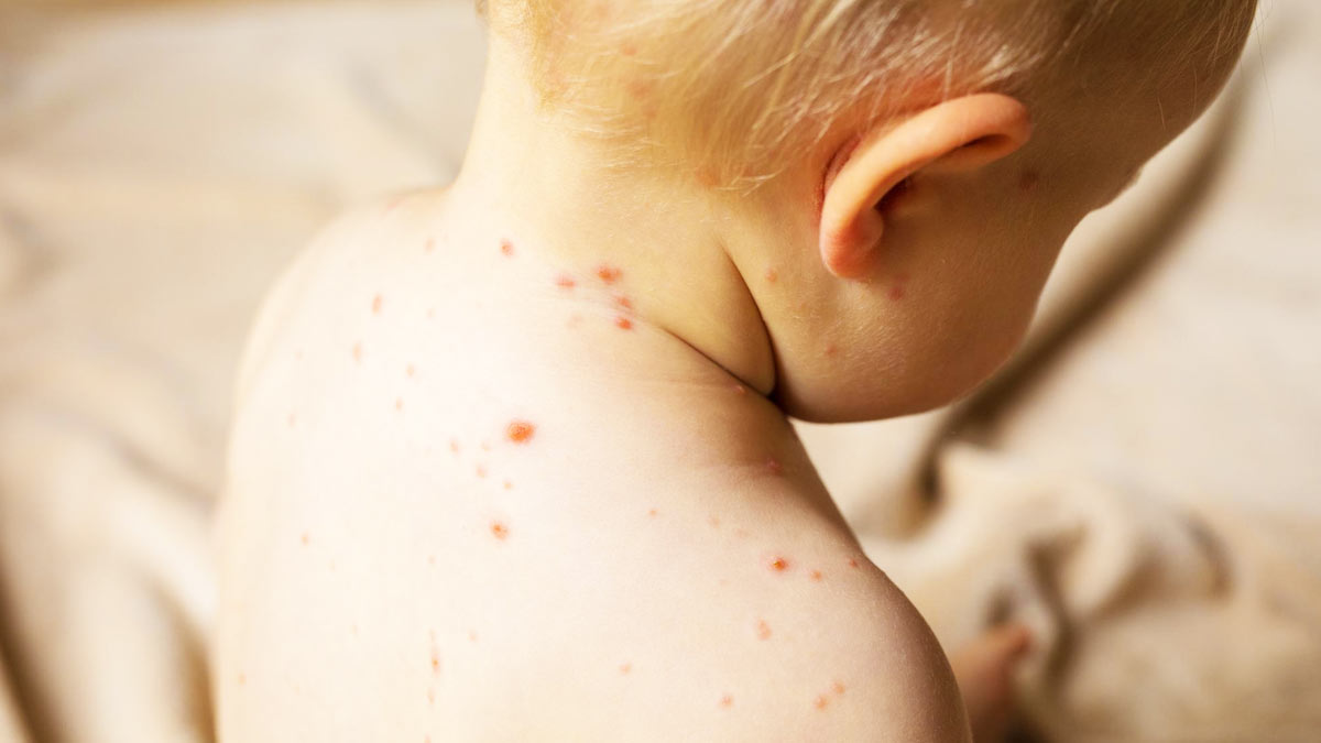 Mumbai Measles Outbreak: Symptoms, Treatment, & More
