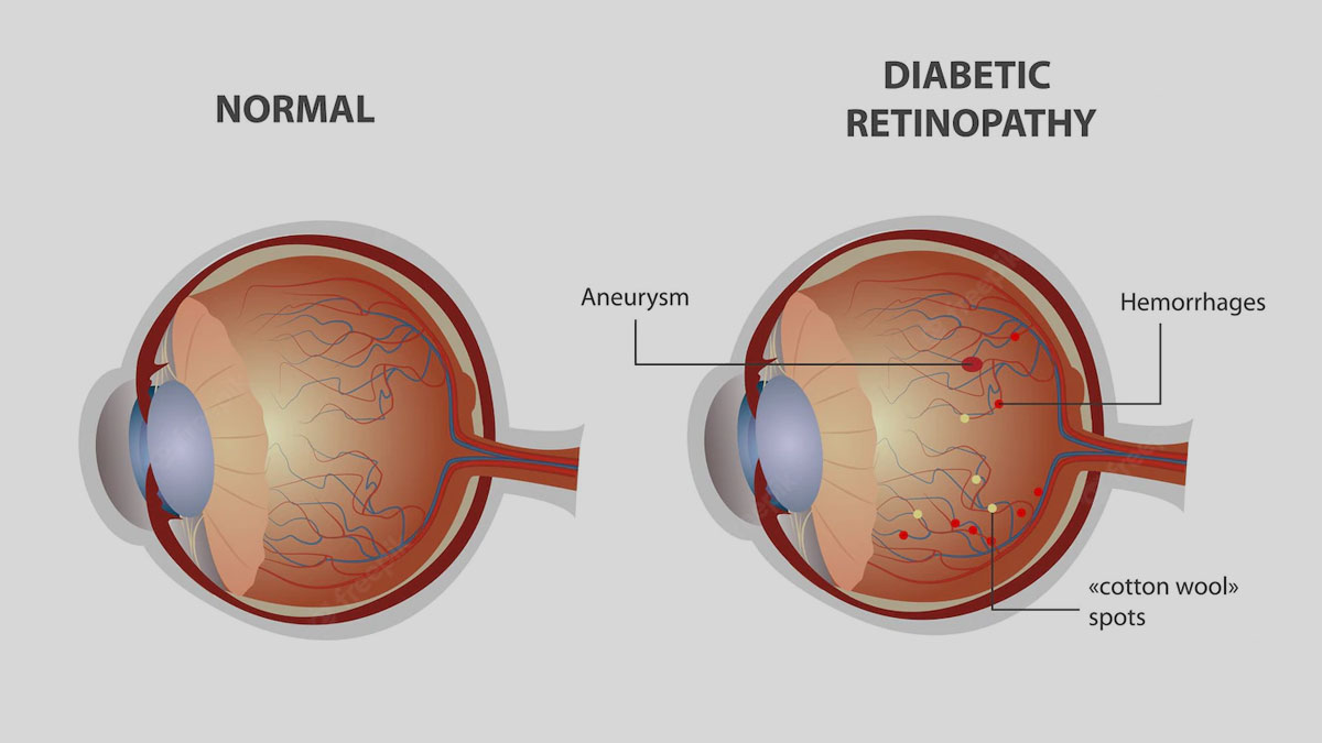 Can Diabetic Eye Disease Be Reversed