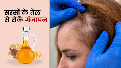सरसों के तेल से रोकें गंजापन, जानें प्रयोग के 4 तरीके