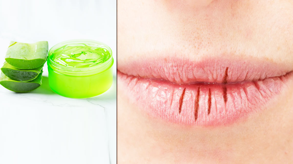 रूखे होठों पर एलोवेरा लगाने के फायदे | how to use aloe vera on lips -  सर्दियों में रूखे होठों को ठीक करेगा एलेवोरा, जानें इस्तेमाल का तरीका