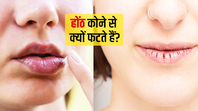 किनारों से क्यों फटते हैं होंठ? जानें कारण और बचाव के तरीके