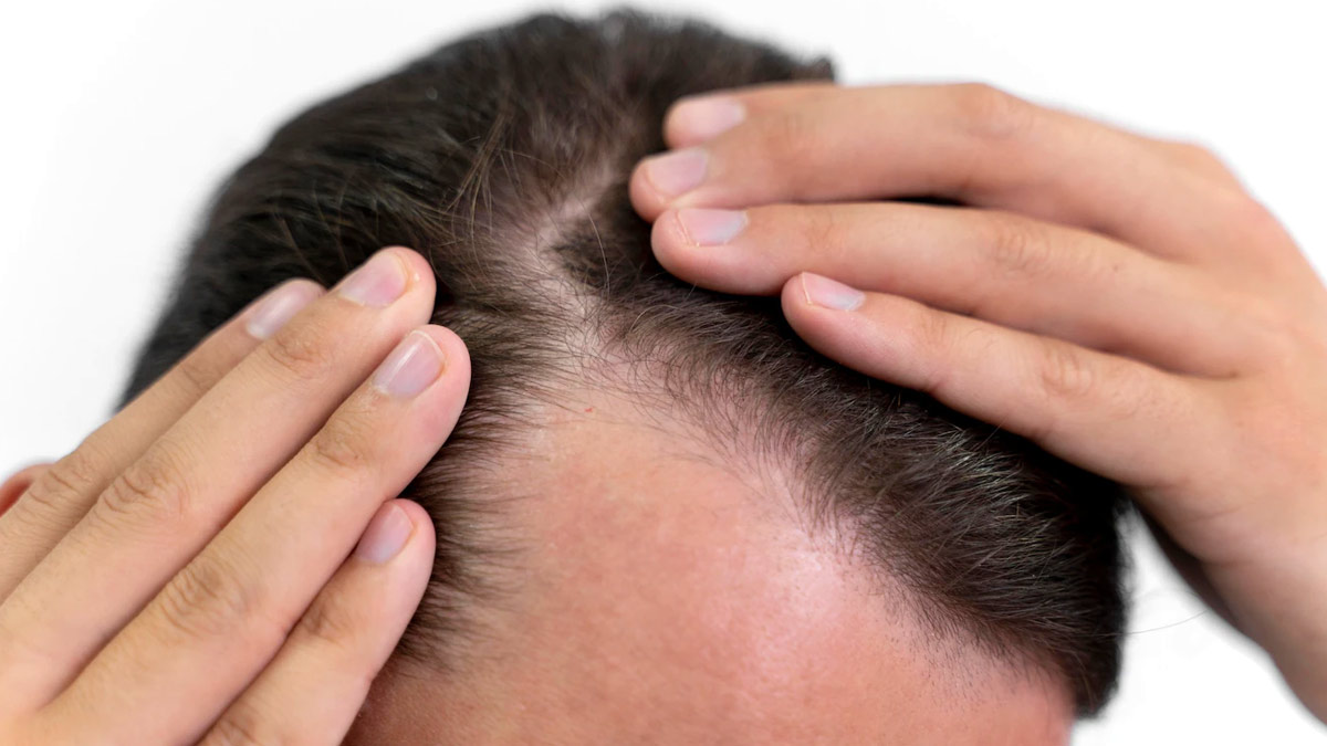 alopecia areata causes in hindi
