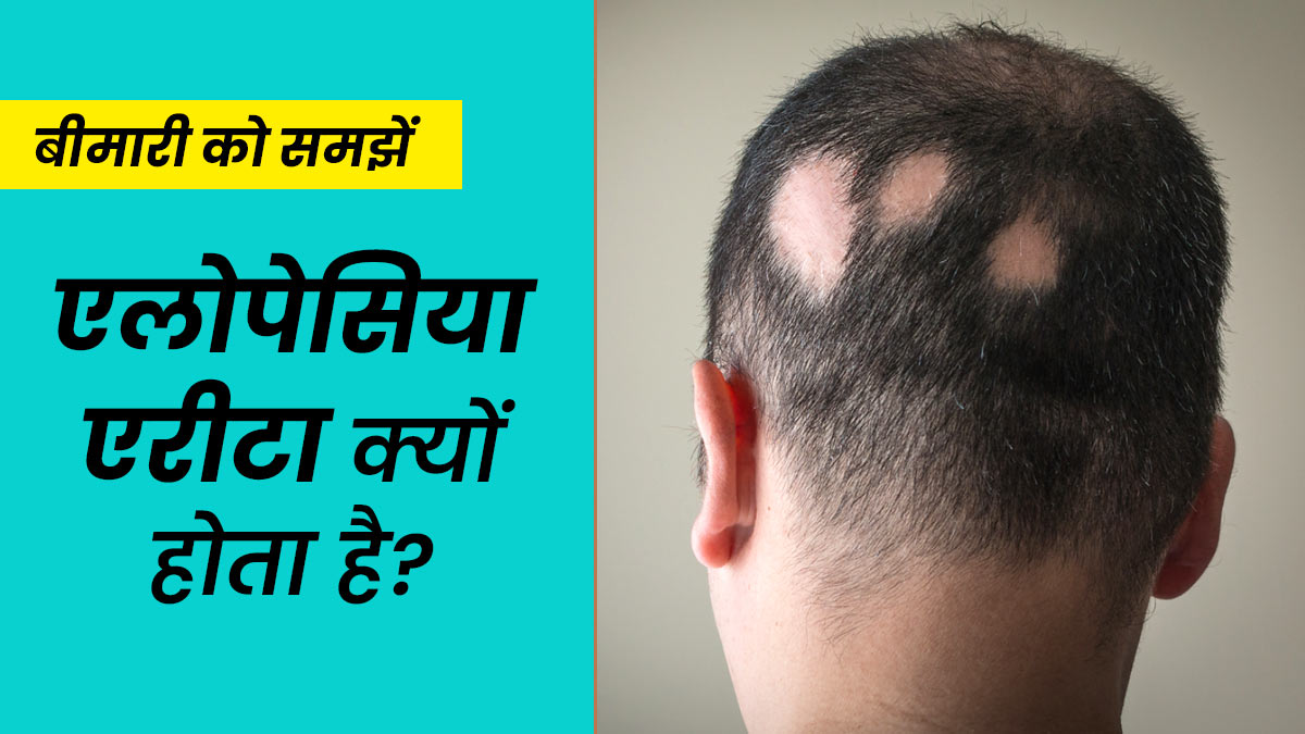 बाल झड़ने की बीमारी (एलोपेसिया) क्यों होती है? डॉक्टर से समझें कारण और इलाज