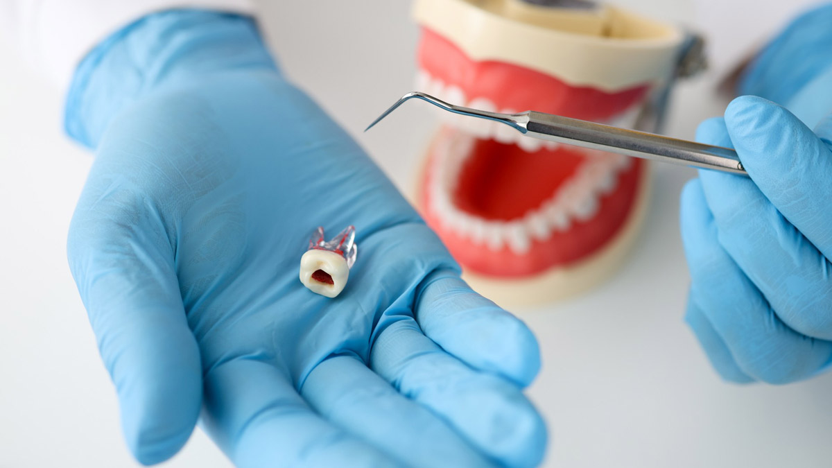 root canal treatment 