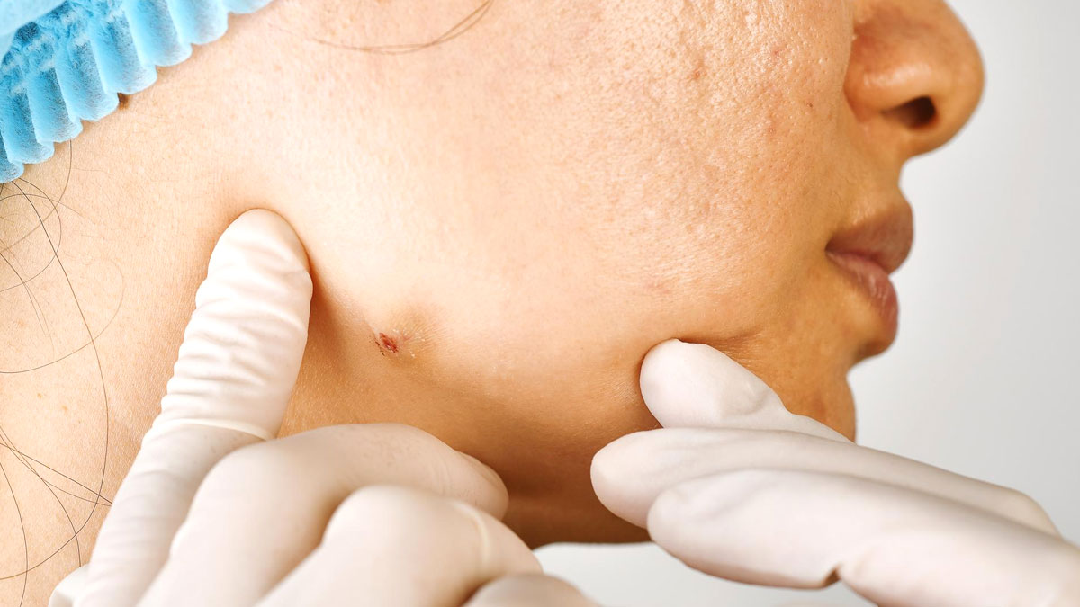 blind pimples in hindi 