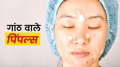 गांठ वाले प‍िंपल्‍स से छुटकारा द‍िलाएंगे ये 5 उपाय