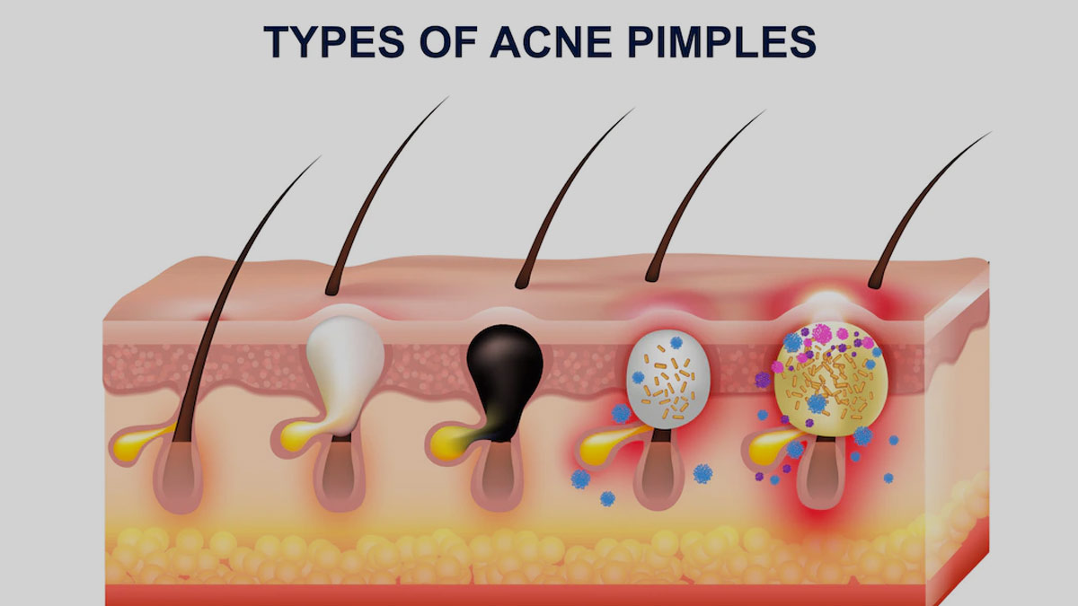 Hormonal Acne In Teenagers: Here's How To Manage It