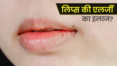 होंठों की एलर्जी से लिप्स हो सकते हैं खराब, इन उपायों से करें घर पर इलाज