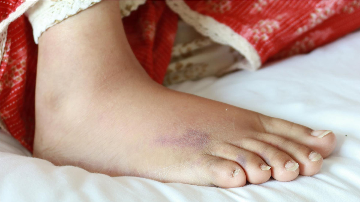 How To Get Rid Of Swelling In Hands And Feet During Winter