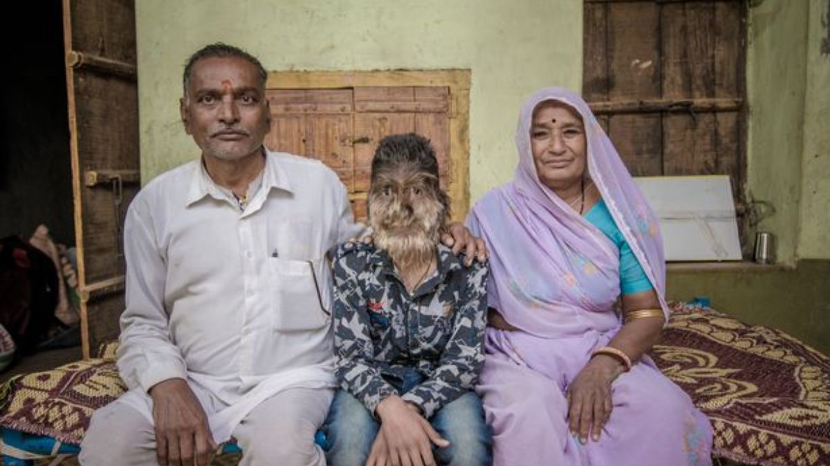 Werewolf Syndrome in Hindi