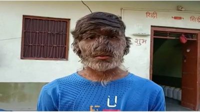 इस गंभीर बीमारी के कारण बंदर जैसा हुआ इस युवक का चेहरा, पूरे शरीर में उगते हैं बाल