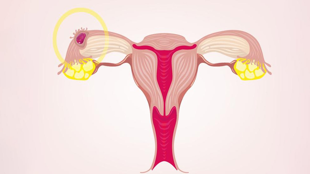 ectopic pregnancy symptoms 