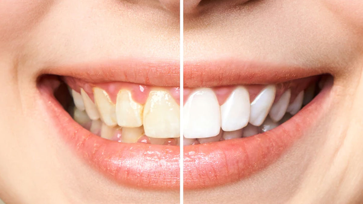 How Safe Is Teeth Whitening
