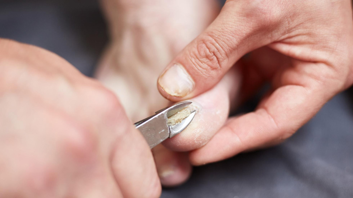 tea tree oil for nail fungus