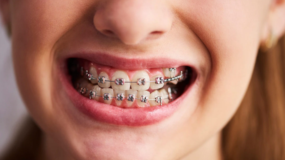 Braces Vs Aligners: Expert Suggests Which Is Better For You