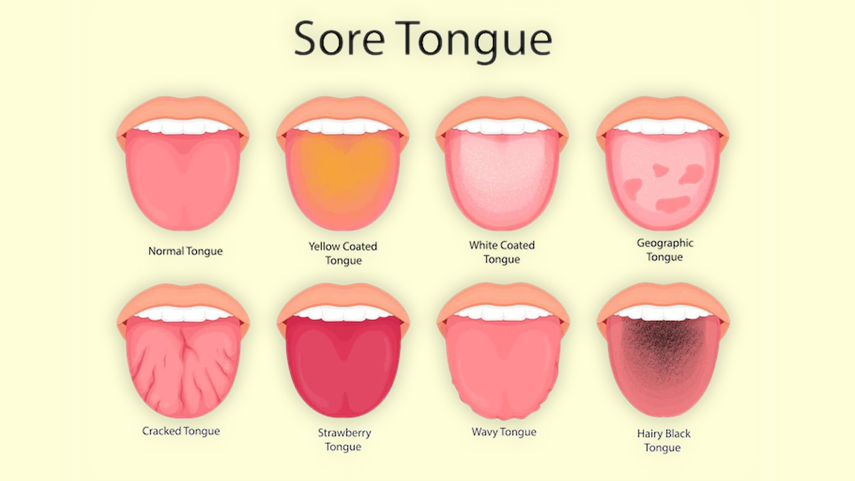 red-patches-on-tongue