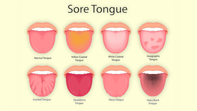 Signs Your Tongue Gives About Your Health