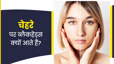 चेहरे पर ब्लैकहेड्स क्यों आते हैं? जानें कारण