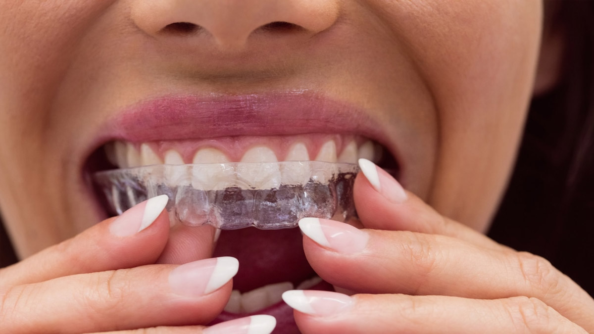 Invisible Braces Vs. Metal Braces: Which Is Better And Why