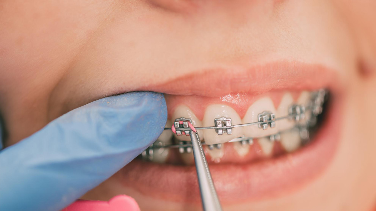 Invisible Braces Vs. Metal Braces: Which Is Better And Why