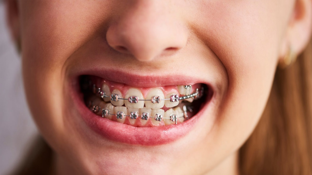 Invisible Braces Vs. Metal Braces: Which Is Better And Why | OnlyMyHealth