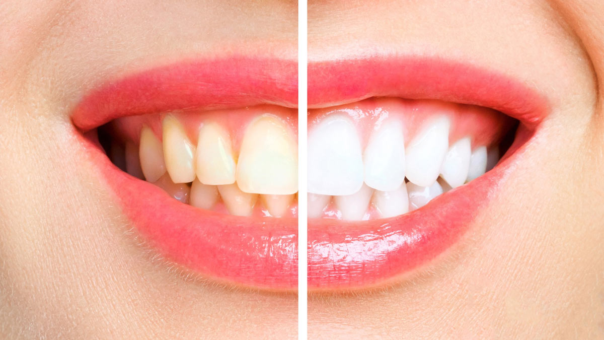 दांतों को मोती जैसे चमकाने के लिए पुदीना, नीम और मुलेठी से बनाएं Teeth Whitening Powder