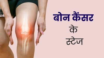 बोन कैंसर के कितने स्टेज होते हैं? जानें कौन स्टेज है बेहद खतरनाक