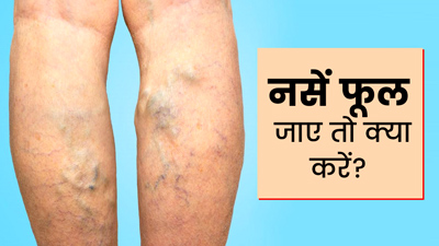 Swollen Veins: नसें फूल जाएं तो क्या करें? अपनाएं ये 6 टिप्स 