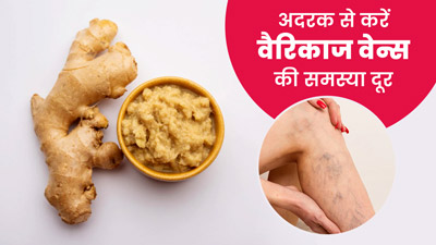 उभरी हुई नीली नसों की परेशानी दूर करेगा अदरक, इस तरह करें इस्तेमाल