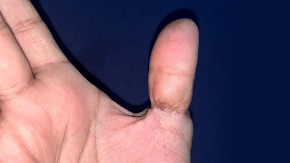 Jammed finger - Wikipedia