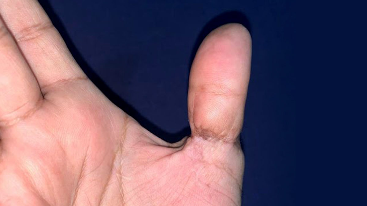 My tight ring is stuck on my swollen finger. I tried lubricating it and it  doesn't work. How can I get it off? - Quora