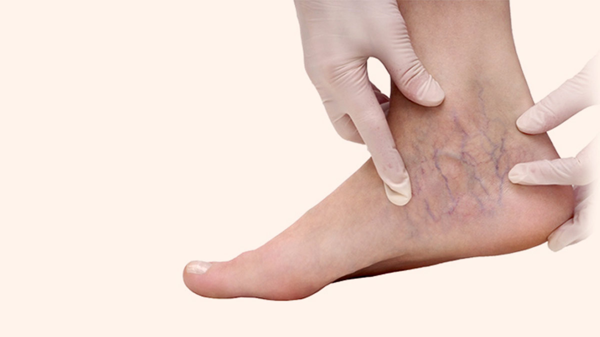 vericose veins on legs