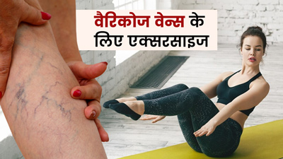 Exercises for Varicose Veins: वैरिकोज वेन्स (नीली नसें) में कौन सी एक्सरसाइज करनी चाहिए?