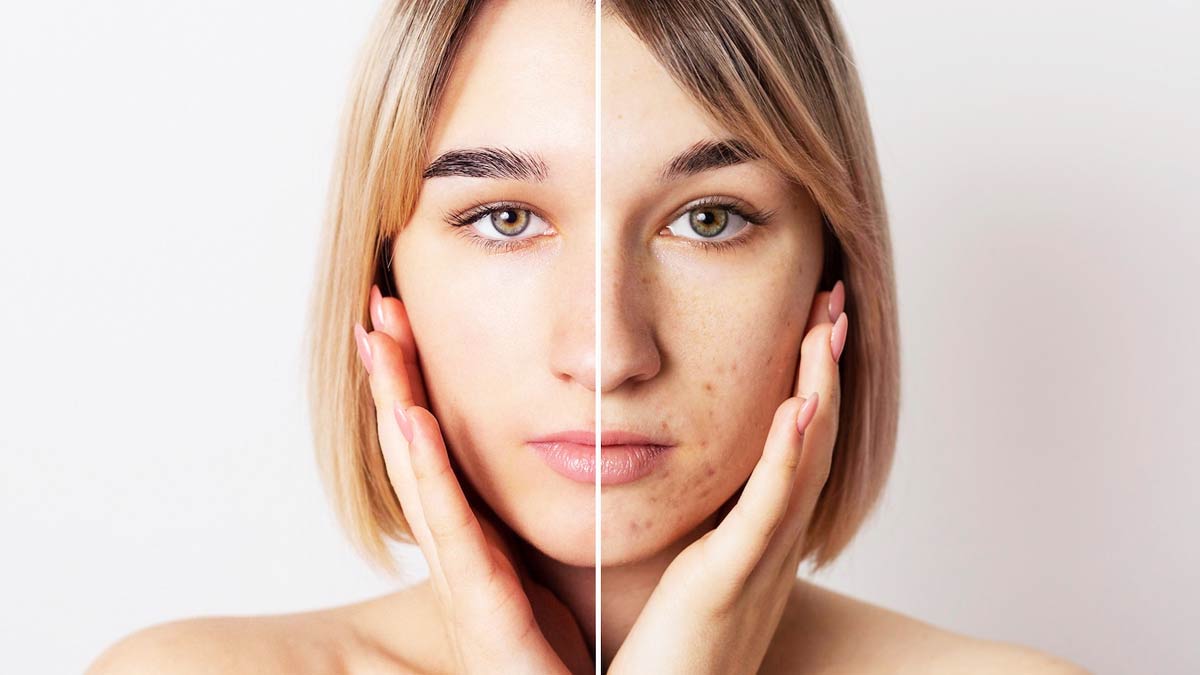 How To Remove Acne Scars With Coconut Oil