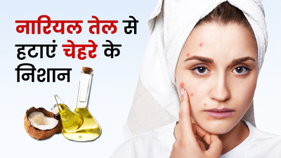 नारियल के तेल से हटाएं मुंहासों के जिद्दी निशान, जानें कैसे करें इस्तेमाल